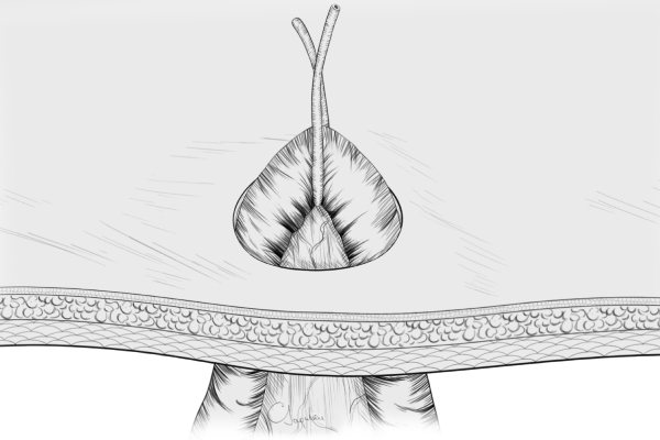 Bağırsaq stomasının qoyulması və ləğvi üzrə təlim